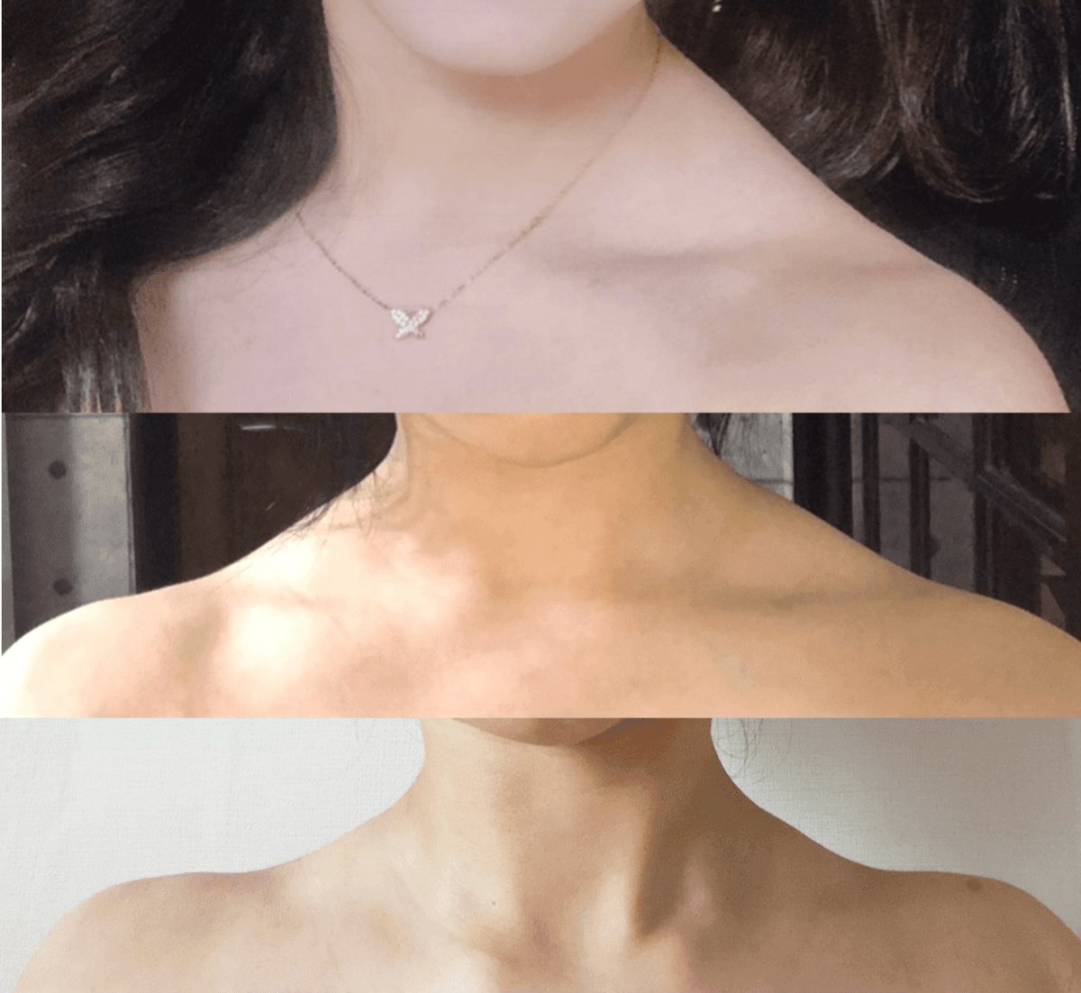 승모근 교정 전후
